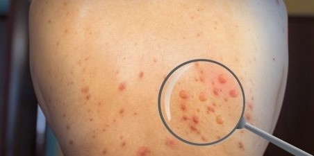 Два случая на маймунска шарка са потвърдени в България